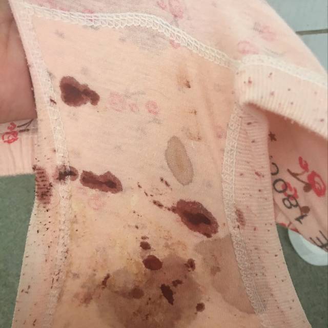 怀孕五个月内裤总是湿 内裤湿多少算是漏羊水