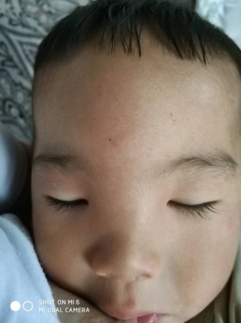 宝宝被蚊子咬 额头 眼皮 鼻子都肿了太吓人了求
