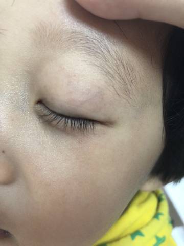 宝宝3周岁 眼睛周围一圈有红点点,最近感冒有