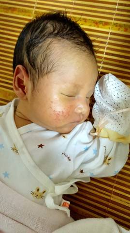 宝宝脸上长湿疹,出生十来天了一直没消怎么办