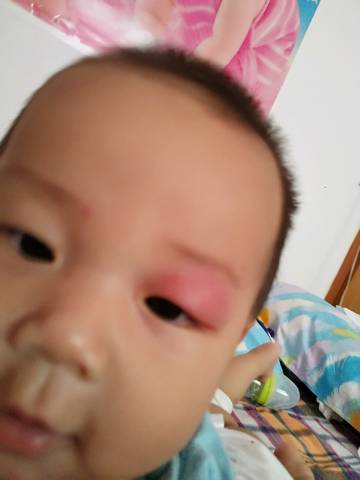 请问宝妈们我家宝宝眼皮子昨天晚上被蚊子咬了