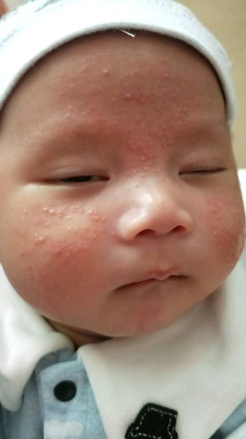 宝宝脸上很多汗疱疹,怎么办啊?