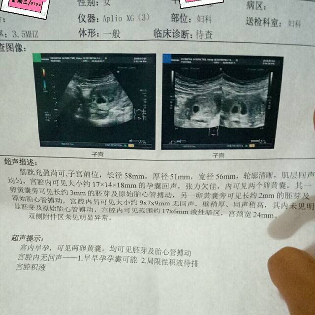 多囊,先兆流产,盆腔积液,见红,双胞胎,剧情齐了