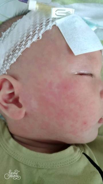 宝宝这星期发烧了三四天,昨天脸上出现红点,怎