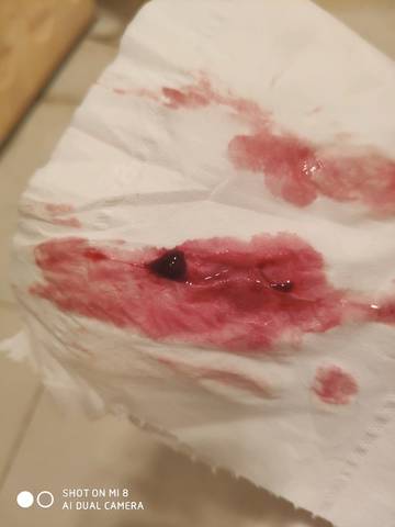 想问下生化妊娠一般多久呀,7月5号白带有褐色