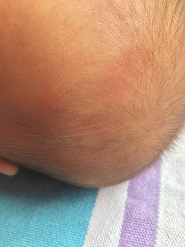 宝宝四个月身上出现红色圆圈,开始只有头顶有