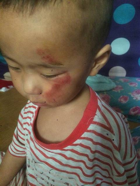 宝宝脸上摔伤了,也不知道会不会留疤,怎么处理