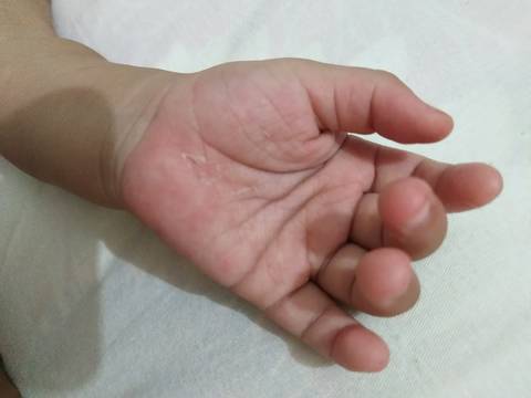 宝宝十一个月手掌脱皮,有没有同样症状的?