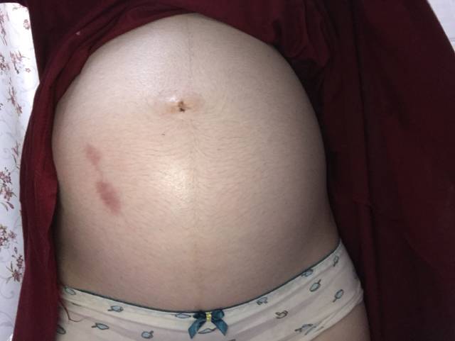 怀孕看男女,左右手拇指回血快。附肚型