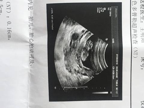 孕12周,会看B超单的宝妈们可以看看是男宝还