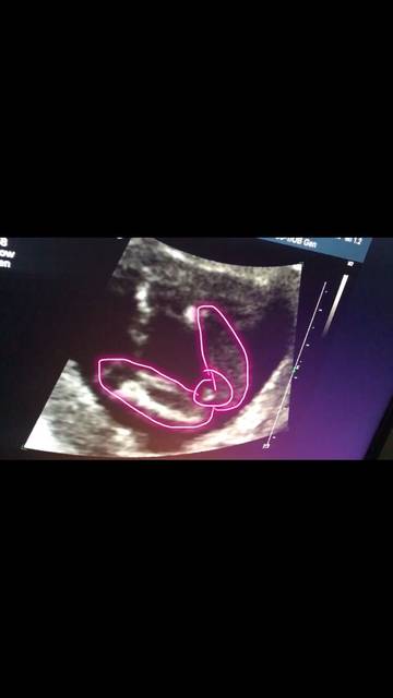 16周已知男宝,附上B超图。孕囊断男女还是挺