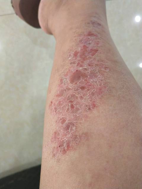 三十七周肚皮痒,腿也痒,但是看不到疙瘩有木有