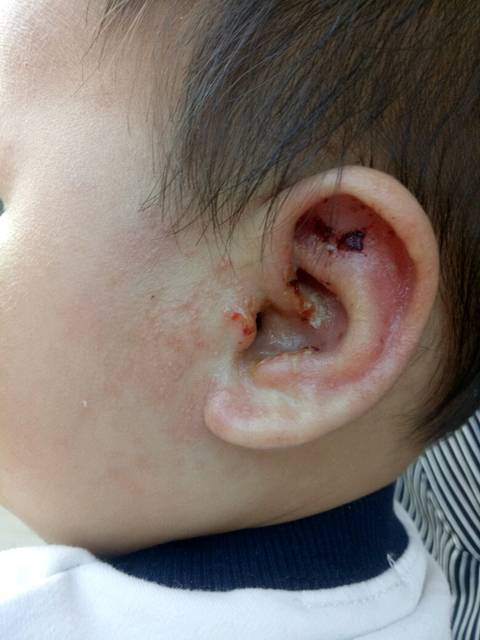 宝宝耳朵湿疹(麻烦有经验的宝妈帮忙看看)