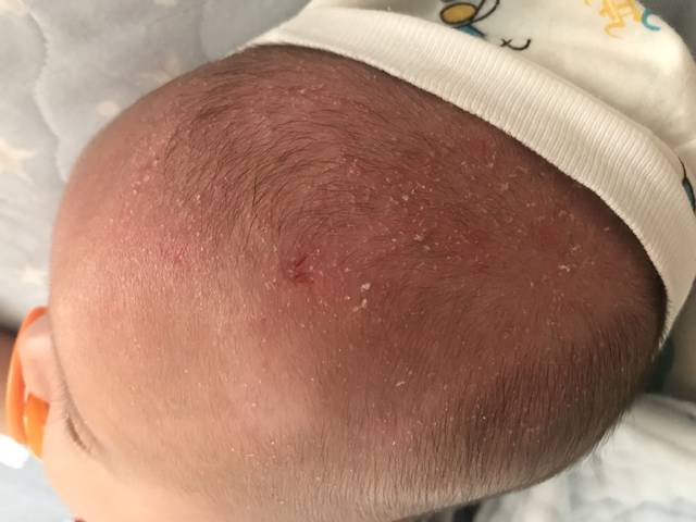 宝宝3个月+,头皮屑是什么原因