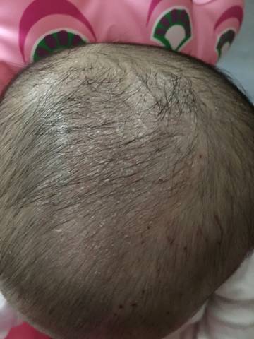 宝宝第二个月开始头上反复长头痂并且痒,宝宝