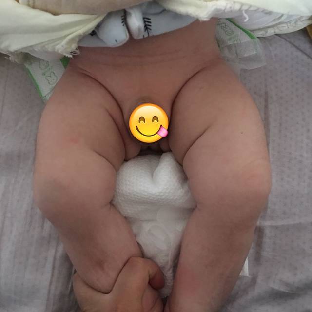 (有图)我宝宝大腿纹不对称咋整啊,应该怎么检查