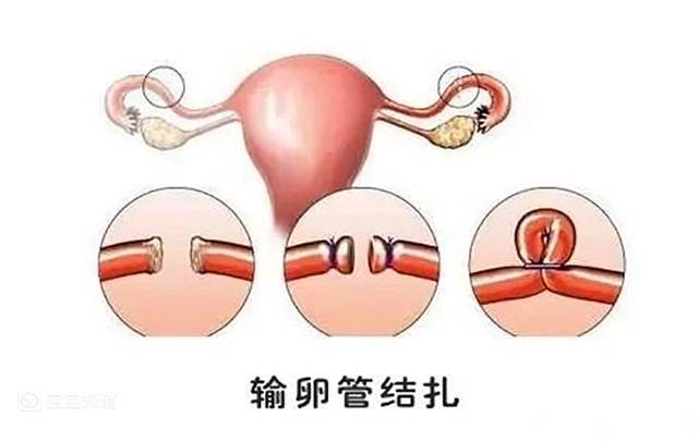 目前女性的结扎就是通过离断或封堵输卵管,阻断精子和卵子的相聚来