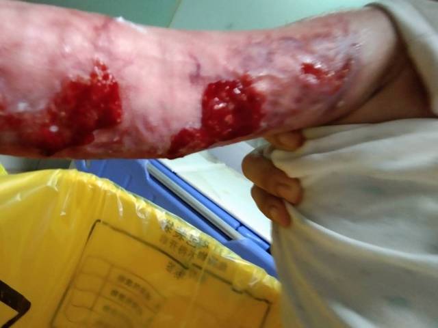 宝宝烫伤伤口怎么愈合快,有图慎入