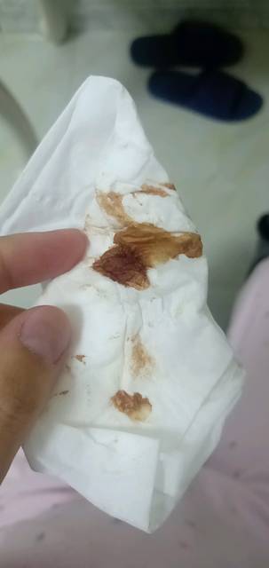 我怀孕37周多了,最近只要一挤乳房,乳头中流出棕色的水