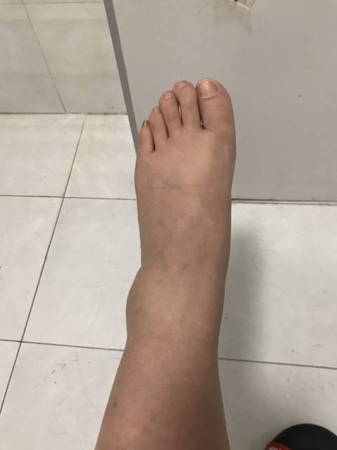 23周啦,妈妈脚开始肿了
