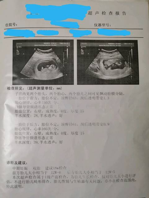 双胞胎nt顺利通过
