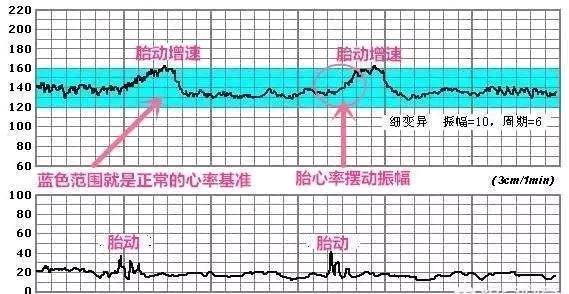 怀孕后几周开始做胎心监护? 教你怎么看胎心监护曲线图!