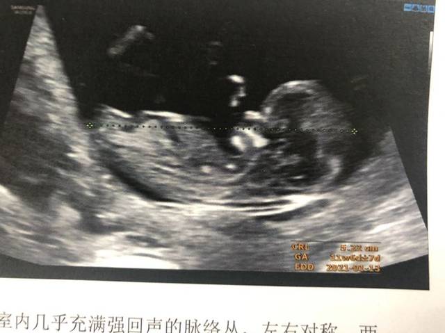 两个宝宝nt图对比,感觉很像啊,有没有会看的,满足下好奇心.