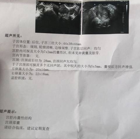 今天去医院检查,这个结果,不是宫外孕,但是会有点出血