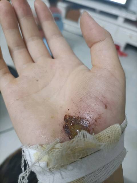两个手都摔伤了 还要看着两个孩子