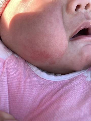 宝宝从出生脸长红血丝 3个月了还没消 一哭