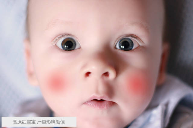 苹果脸、嘴唇干…秋冬宝宝皮肤护理你一定要知