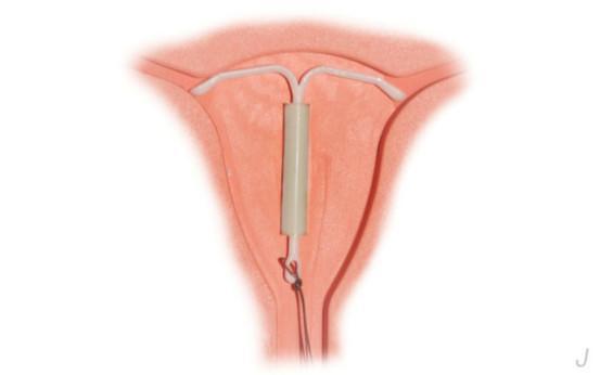 节育环不取后果很严重,错过取环最佳时间只会