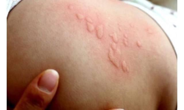 儿童过敏性荨麻疹初期图片