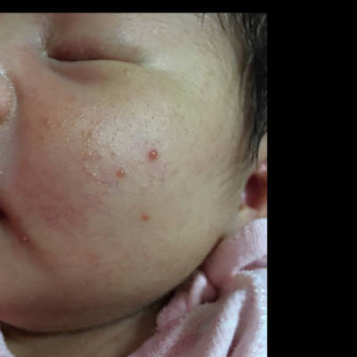宝宝脸上湿疹红血丝图图片