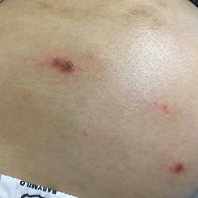 请问我肚皮上的是湿疹吗?该怎麼处理,好痒.