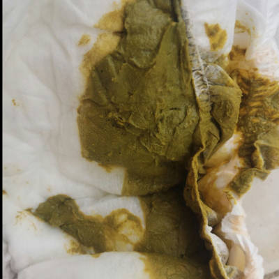 一个月13天的宝宝这两天拉的粑粑是这个色的 正常吗?
