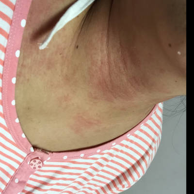 颈部湿疹的症状图片图片