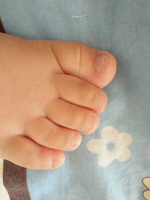 宝宝脚趾甲分层发白