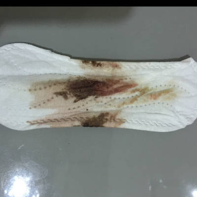 19号 8月17日发现怀孕了!连续1个星期出血量少伴有鲜血.