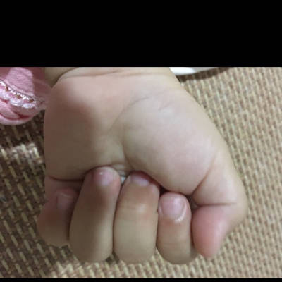 宝宝14个月多 刚发现大拇指伸不直 怎麼回事啊