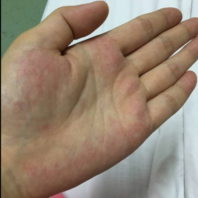 但是不脱皮                 医生在线 专家问答 母乳餵养 婴儿辅食