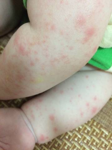 三个月宝宝身上红疹图图片