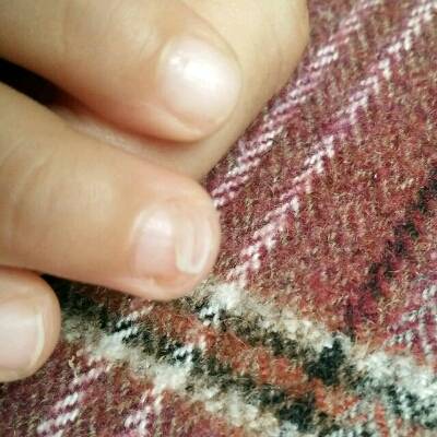 我家宝宝33个月出现手指甲发白然后脱指甲的情况,网上说是缺钙和微量