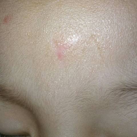 孩子摔伤伤口很深,留下的疤痕有没有一种效果好的能淡化疤痕的?谢谢