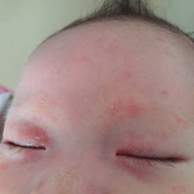 3个月宝宝眼皮红图片图片