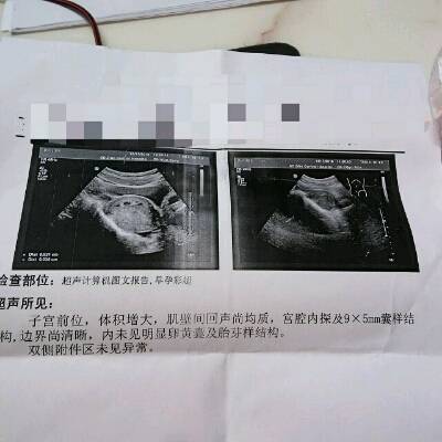 未怀孕的彩超图图片