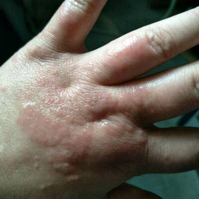 会痒,抓了就更厉害