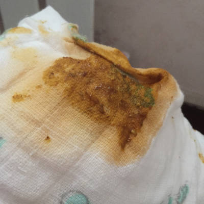 孩子大便这个颜色,是怎麼了?怎麼办