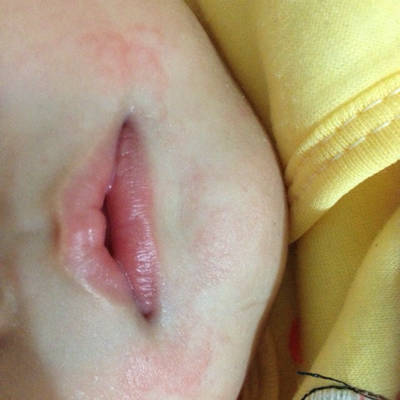 孩子嘴边起红疹子照片图片