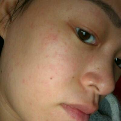 我怀孕后脸上红点点特别明显,不知道是过敏还是怀孕引起的,就脸颊两边